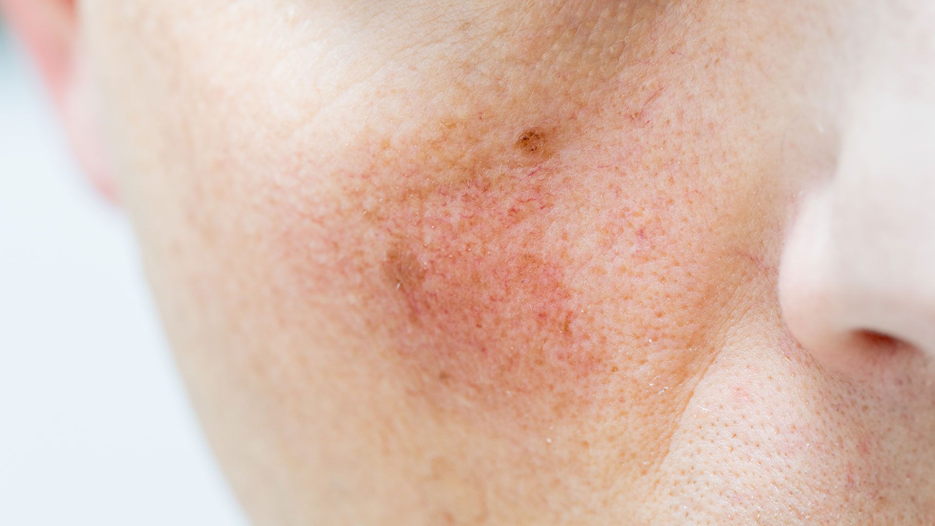 Rosacea Awareness Rises: A Friendly Guide to Managing the Skin Condition That Affects Millions